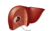 Liver cancers