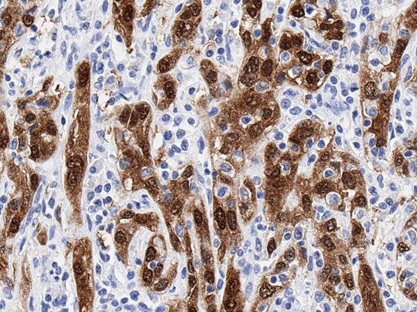 p16_Cervical-adenocarcinoma