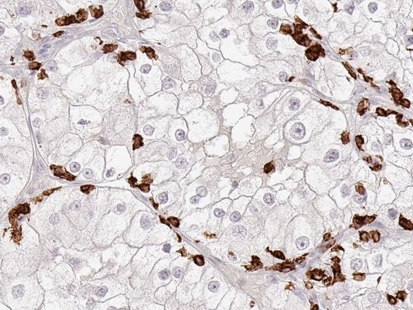 CD8_Kidney-cancer