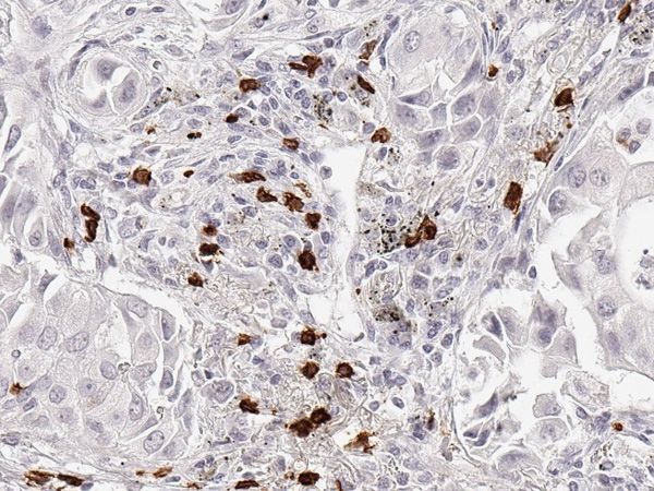 CD8_Lung-Adenocarcinoma