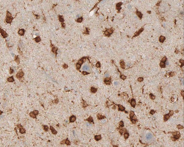 IDH1-R132H-Cortex-infiltrated-by-oligodendroglioma