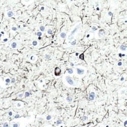 Tau staining of paraffin-embedded Alzheimer's 'brain'.