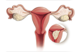 Uterine cancers